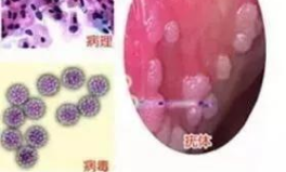尖锐湿疣是什么,病因、症状及预防措施
